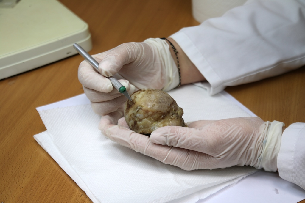 Badają kości do szpiku kości